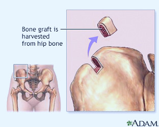 Bone graft Information | Mount Sinai - New York